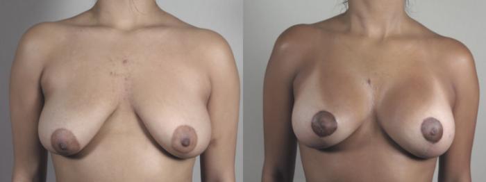 Breast Lift with Implants Case 1358 Before & After Front | Paramus, New Jersey | Parker Center for Plastic Surgery