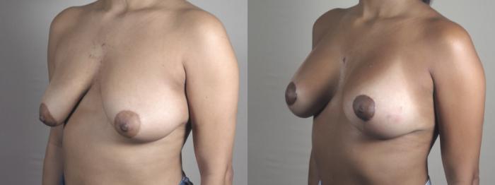 Breast Lift with Implants Case 1358 Before & After Left Oblique | Paramus, New Jersey | Parker Center for Plastic Surgery