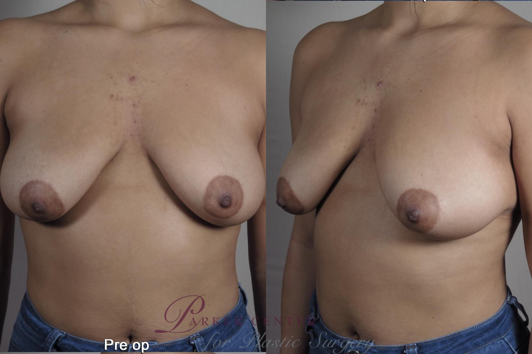 Breast Lift with Implants Case 1358 Before & After pre op  | Paramus, New Jersey | Parker Center for Plastic Surgery