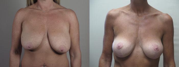 Breast Lift with Implants Case 1412 Before & After Front | Paramus, New Jersey | Parker Center for Plastic Surgery