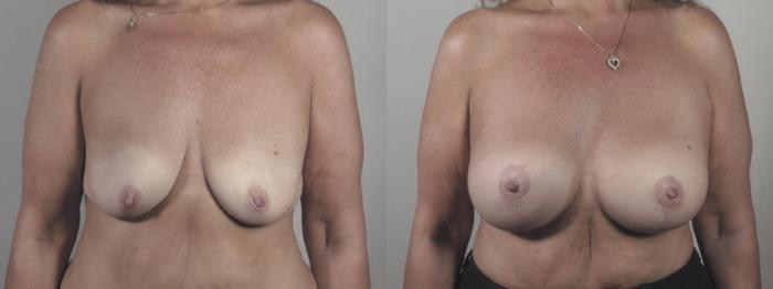 Breast Lift with Implants Case 1423 Before & After Front | Paramus, New Jersey | Parker Center for Plastic Surgery