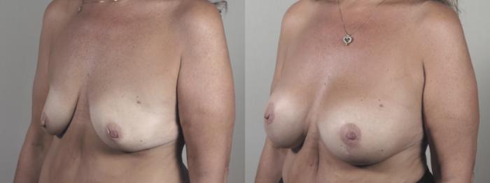 Breast Lift with Implants Case 1423 Before & After Side view | Paramus, New Jersey | Parker Center for Plastic Surgery