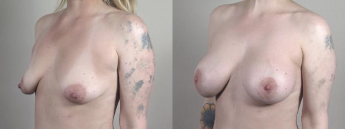 Breast Lift with Implants Case 1458 Before & After Left Oblique | Paramus, New Jersey | Parker Center for Plastic Surgery