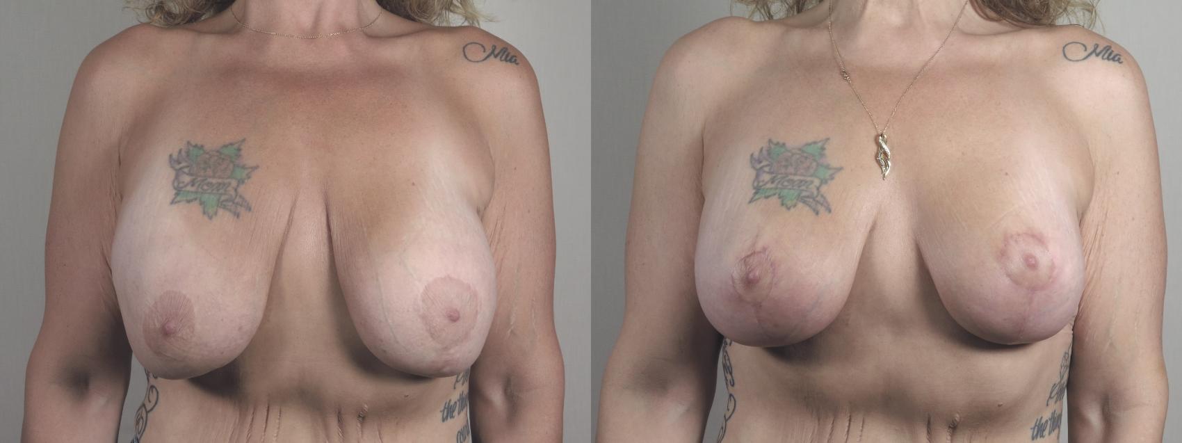 Breast Lift with Implants Case 1473 Before & After Front | Paramus, New Jersey | Parker Center for Plastic Surgery