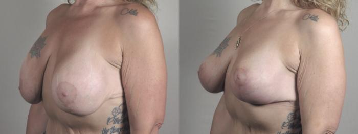 Breast Lift with Implants Case 1473 Before & After Left Oblique | Paramus, New Jersey | Parker Center for Plastic Surgery