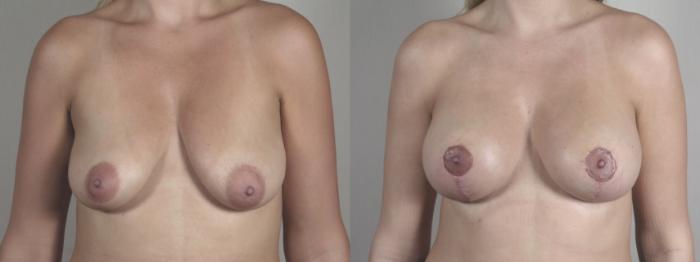 Breast Lift with Implants Case 1474 Before & After Front | Paramus, New Jersey | Parker Center for Plastic Surgery