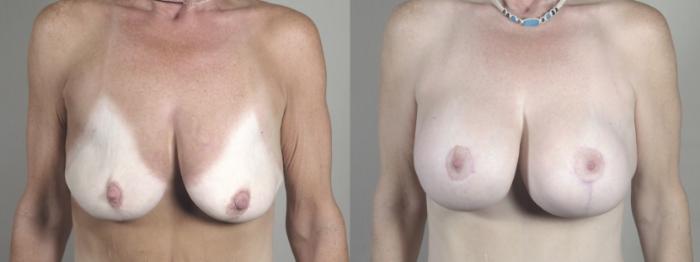 Breast Lift with Implants Case 1502 Before & After Front | Paramus, New Jersey | Parker Center for Plastic Surgery