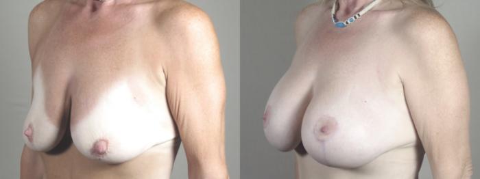 Breast Lift with Implants Case 1502 Before & After Left Oblique | Paramus, New Jersey | Parker Center for Plastic Surgery