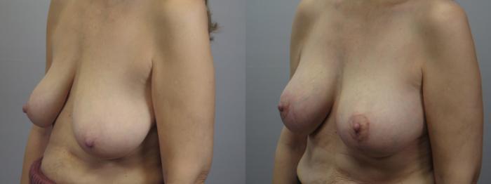 Breast Lift with Implants Case 1614 Before & After Left Oblique | Paramus, New Jersey | Parker Center for Plastic Surgery