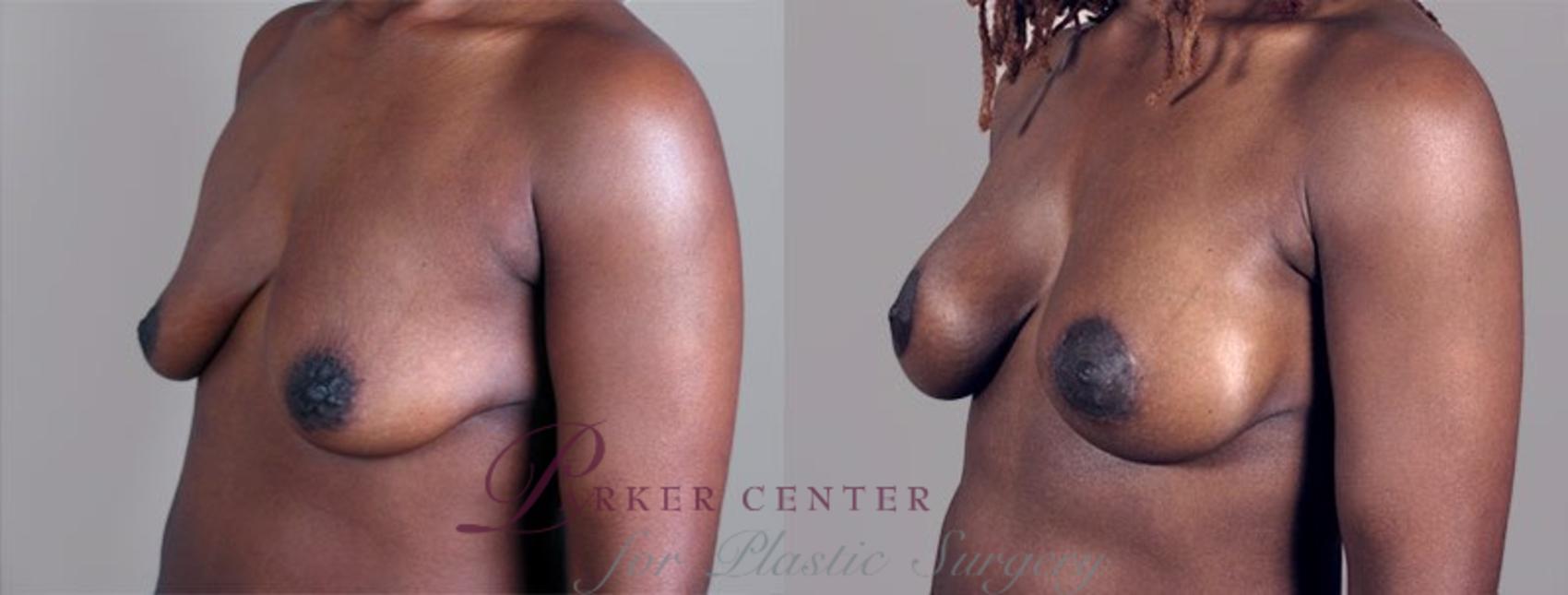 Breast Asymmetry Case 449 Before & After View #2 | Paramus, NJ | Parker Center for Plastic Surgery