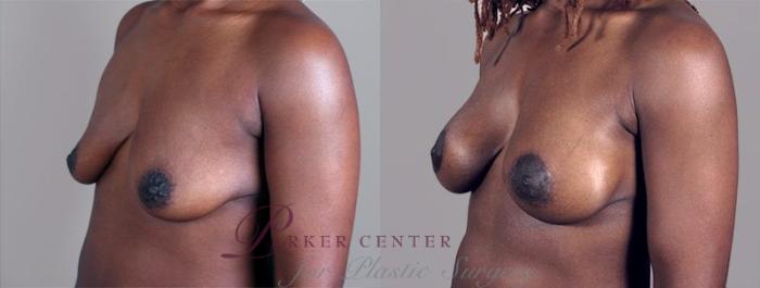 Breast Lift with Implants Case 449 Before & After View #2 | Paramus, NJ | Parker Center for Plastic Surgery