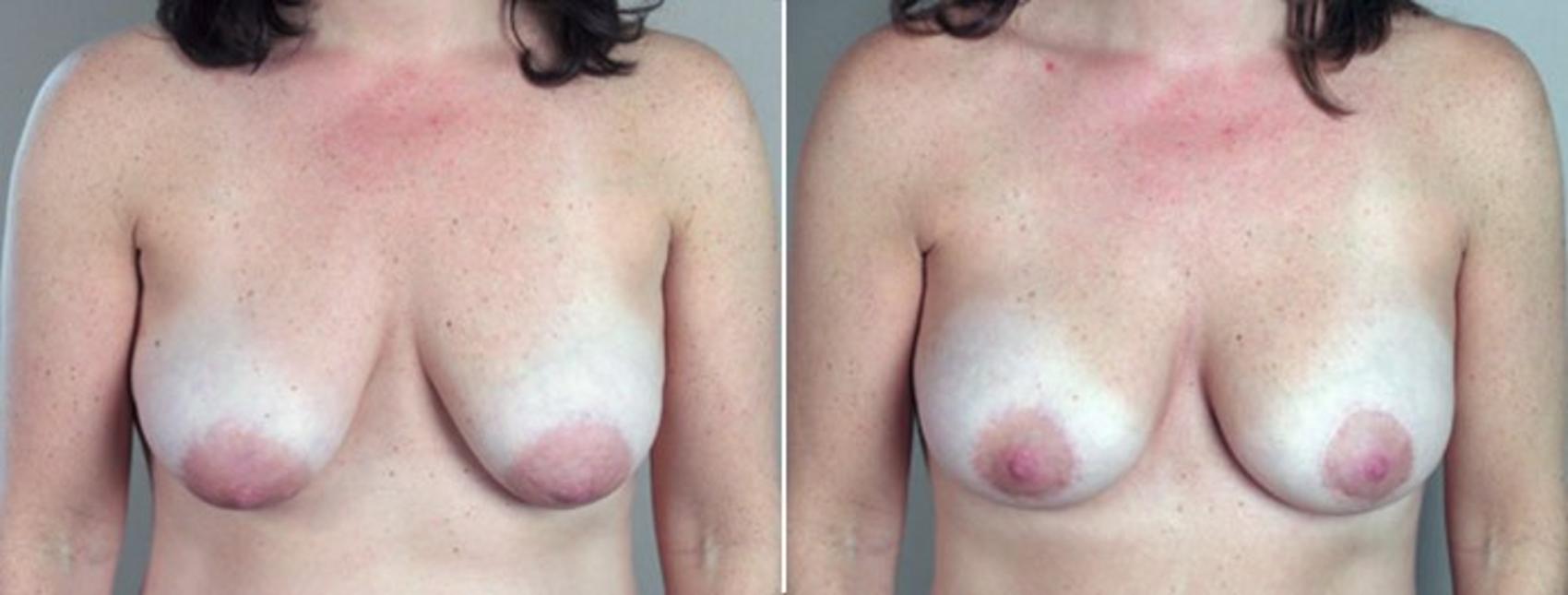 Breast Lift with Implants Case 450 Before & After View #1 | Paramus, NJ | Parker Center for Plastic Surgery