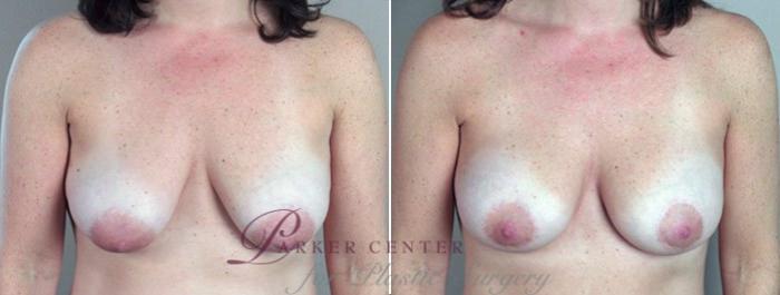 Breast Lift with Implants Case 450 Before & After View #1 | Paramus, NJ | Parker Center for Plastic Surgery