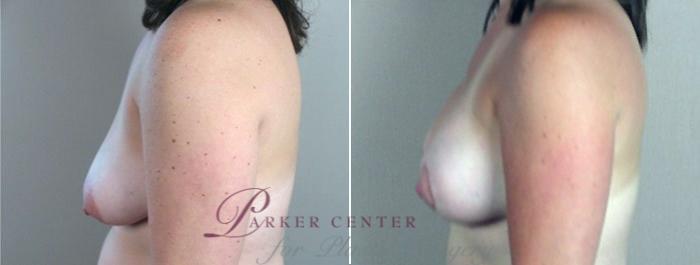Breast Lift with Implants Case 450 Before & After View #5 | Paramus, NJ | Parker Center for Plastic Surgery