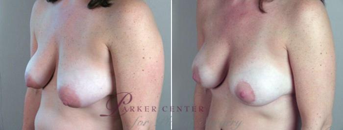 Breast Lift with Implants Case 450 Before & After View #6 | Paramus, NJ | Parker Center for Plastic Surgery