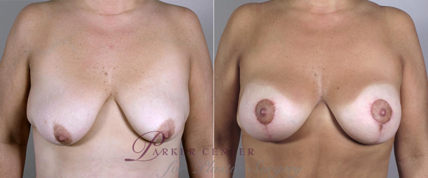 Breast Lift with Implants Case 451 Before & After View #1 | Paramus, NJ | Parker Center for Plastic Surgery