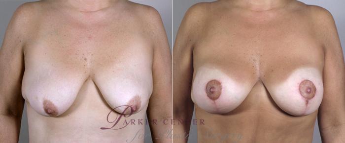 Breast Lift with Implants Case 451 Before & After View #1 | Paramus, NJ | Parker Center for Plastic Surgery