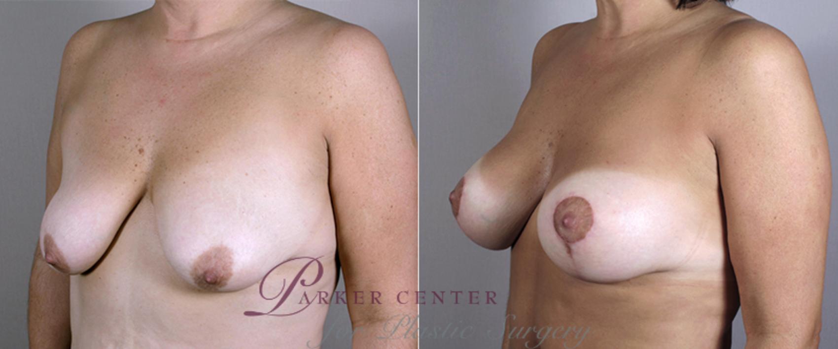 Breast Lift with Implants Case 451 Before & After View #2 | Paramus, NJ | Parker Center for Plastic Surgery