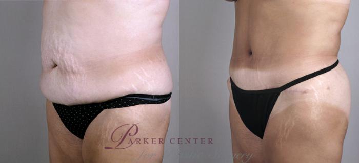 Mommy Makeover Case 451 Before & After View #4 | Paramus, NJ | Parker Center for Plastic Surgery