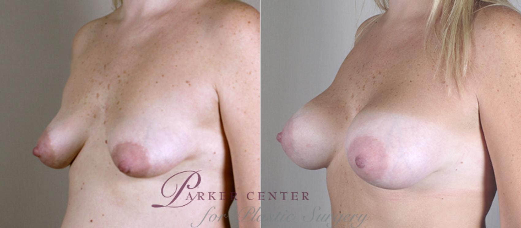 Breast Lift with Implants Case 452 Before & After View #2 | Paramus, New Jersey | Parker Center for Plastic Surgery