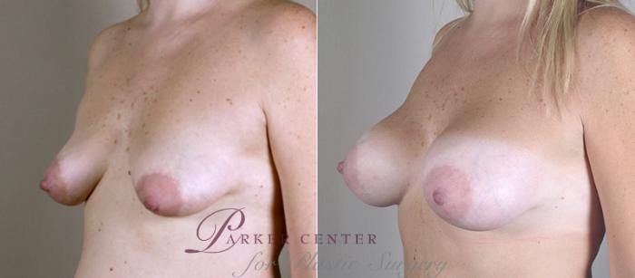 Breast Lift with Implants Case 452 Before & After View #2 | Paramus, NJ | Parker Center for Plastic Surgery