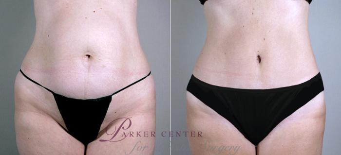 Breast Lift with Implants Case 452 Before & After View #3 | Paramus, NJ | Parker Center for Plastic Surgery