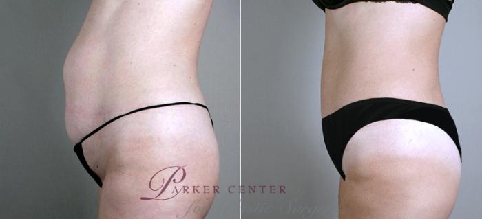 Mommy Makeover Case 452 Before & After View #4 | Paramus, NJ | Parker Center for Plastic Surgery
