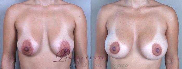 Breast Lift with Implants Case 453 Before & After View #1 | Paramus, NJ | Parker Center for Plastic Surgery