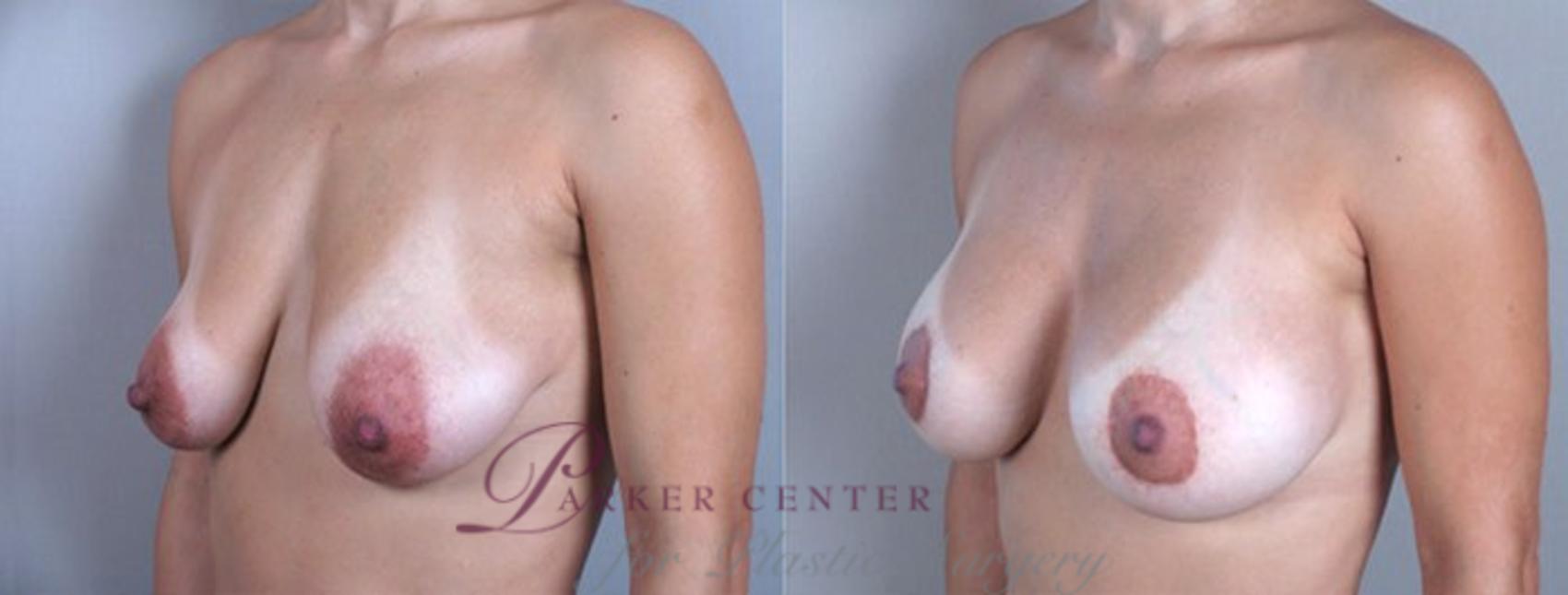 Breast Lift with Implants Case 453 Before & After View #2 | Paramus, New Jersey | Parker Center for Plastic Surgery