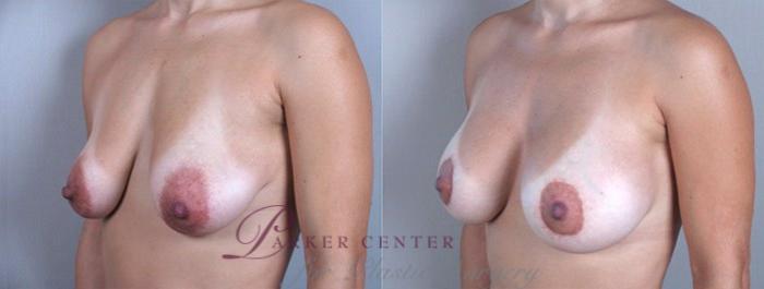 Breast Lift with Implants Case 453 Before & After View #2 | Paramus, NJ | Parker Center for Plastic Surgery