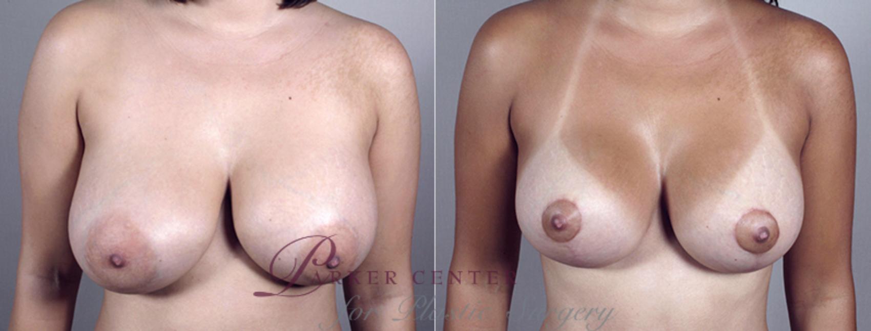 Breast Implant Revision Case 454 Before & After View #1 | Paramus, NJ | Parker Center for Plastic Surgery