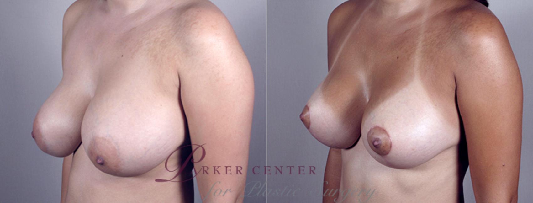Breast Implant Revision Case 454 Before & After View #2 | Paramus, NJ | Parker Center for Plastic Surgery