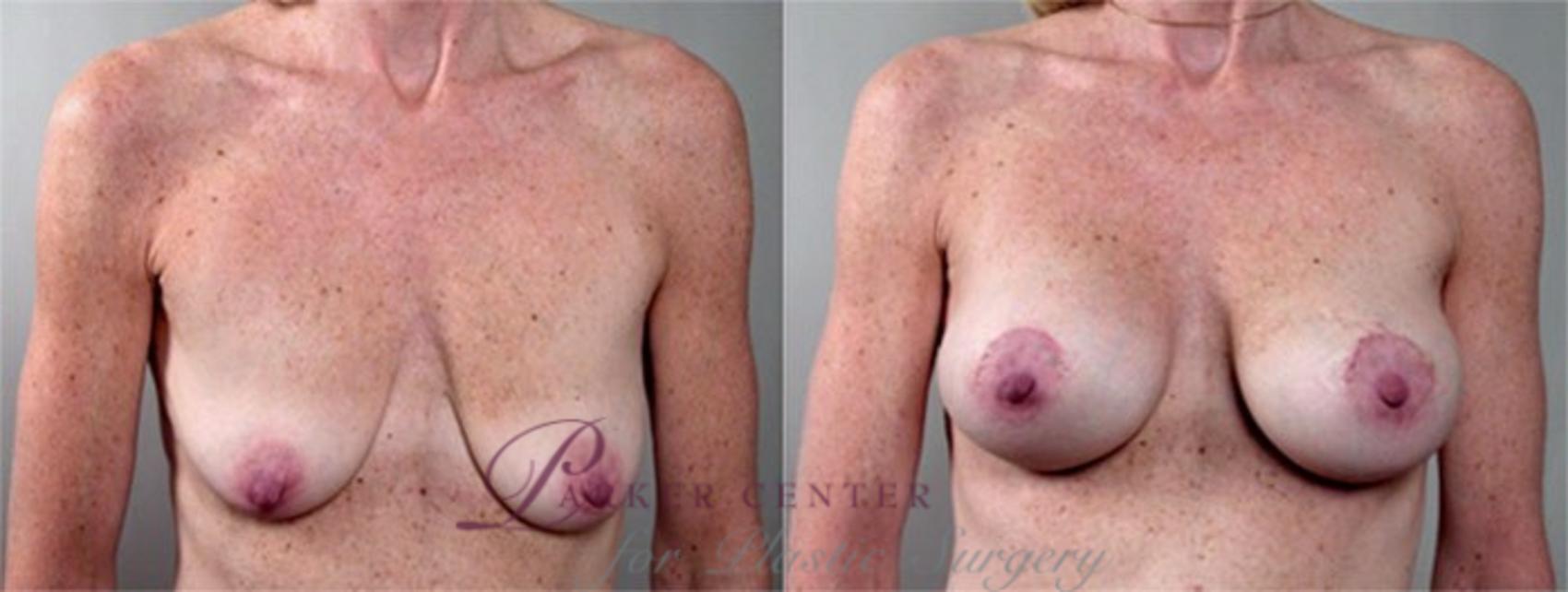 Breast Lift with Implants Case 455 Before & After View #1 | Paramus, NJ | Parker Center for Plastic Surgery