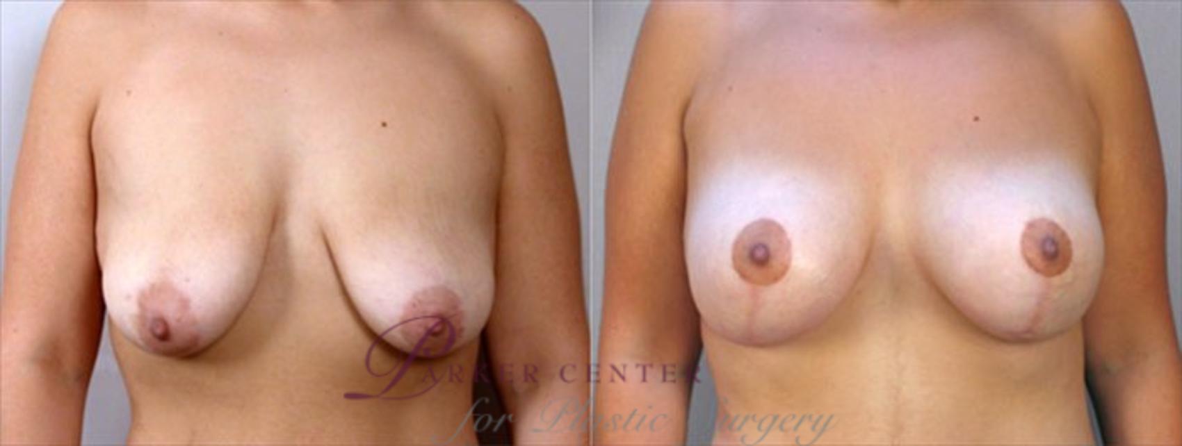 Breast Lift with Implants Case 457 Before & After View #1 | Paramus, NJ | Parker Center for Plastic Surgery