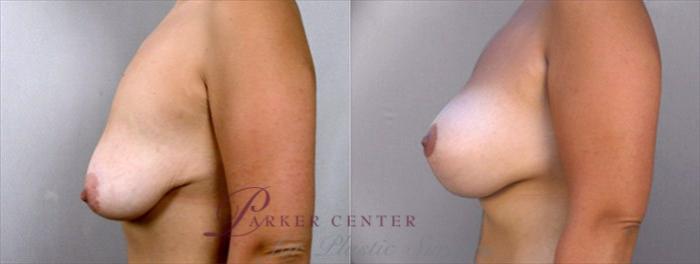 Breast Lift with Implants Case 457 Before & After View #2 | Paramus, NJ | Parker Center for Plastic Surgery