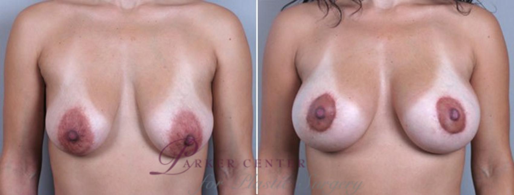 Breast Lift with Implants Case 458 Before & After View #1 | Paramus, NJ | Parker Center for Plastic Surgery