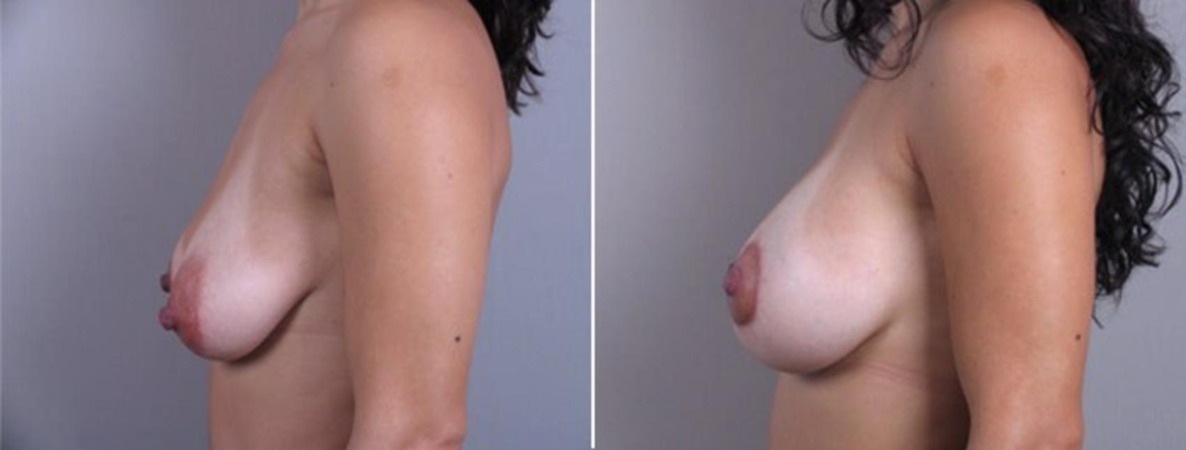 Breast Lift with Implants Case 458 Before & After View #2 | Paramus, New Jersey | Parker Center for Plastic Surgery