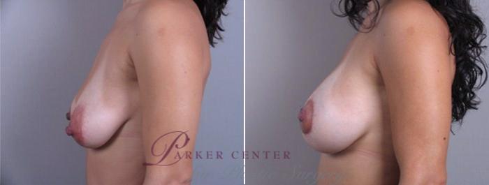 Breast Lift with Implants Case 458 Before & After View #2 | Paramus, NJ | Parker Center for Plastic Surgery