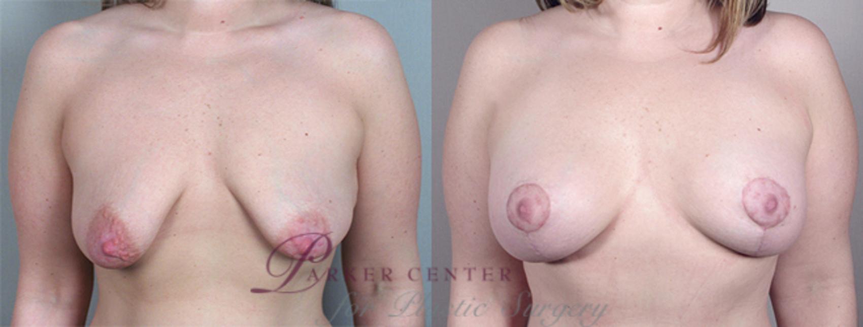 Breast Lift with Implants Case 459 Before & After View #1 | Paramus, NJ | Parker Center for Plastic Surgery