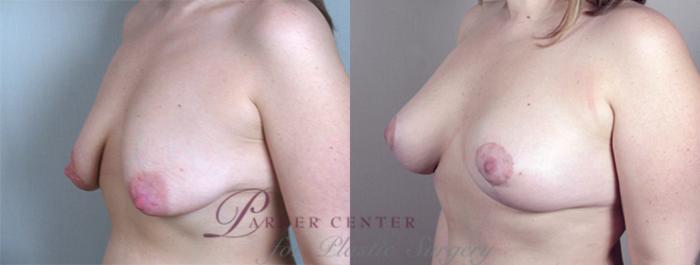 Breast Lift with Implants Case 459 Before & After View #2 | Paramus, NJ | Parker Center for Plastic Surgery