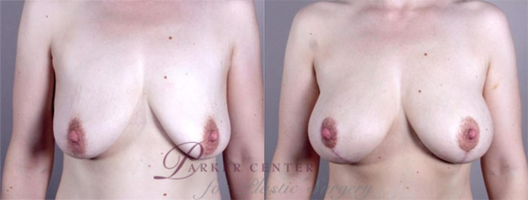 Breast Lift with Implants Case 460 Before & After View #1 | Paramus, NJ | Parker Center for Plastic Surgery