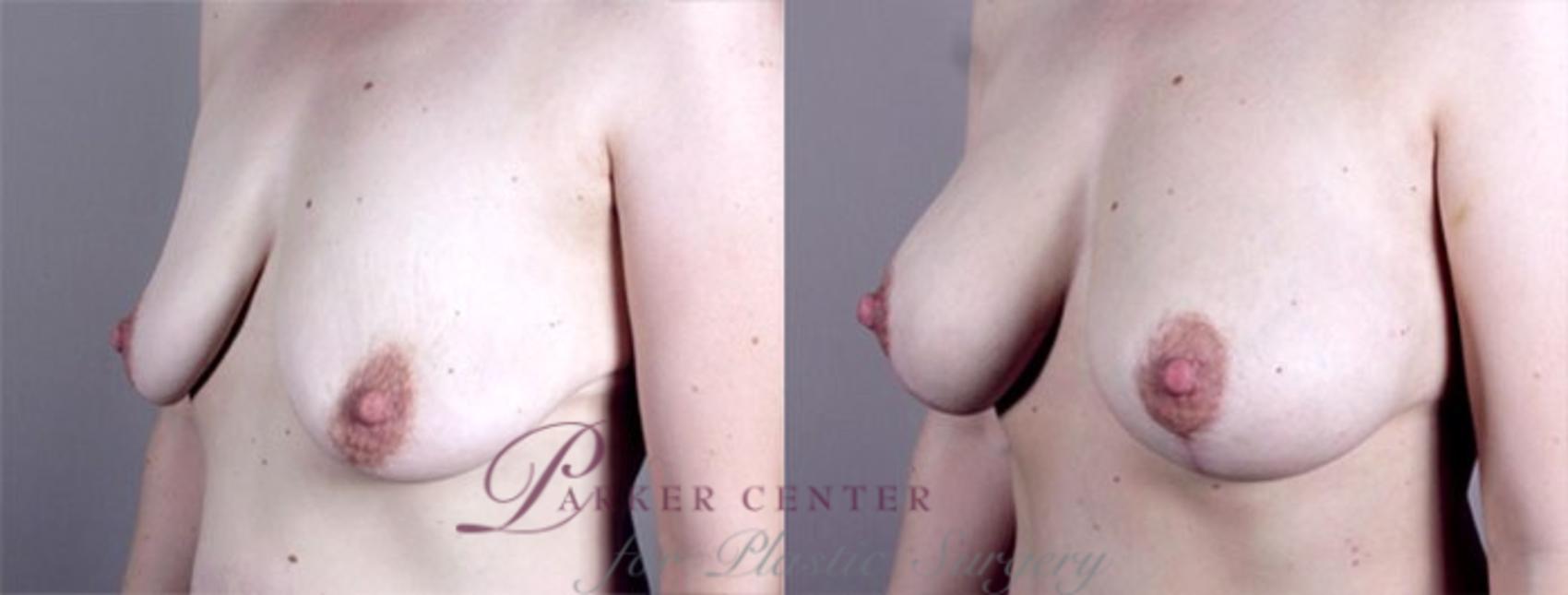 Breast Lift with Implants Case 460 Before & After View #2 | Paramus, NJ | Parker Center for Plastic Surgery