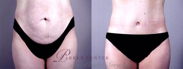Mommy Makeover Case 460 Before & After View #3 | Paramus, NJ | Parker Center for Plastic Surgery