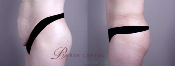 Mommy Makeover Case 460 Before & After View #4 | Paramus, NJ | Parker Center for Plastic Surgery