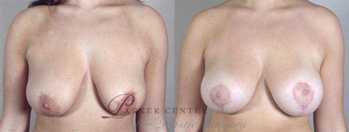 Breast Asymmetry Case 462 Before & After View #1 | Paramus, NJ | Parker Center for Plastic Surgery