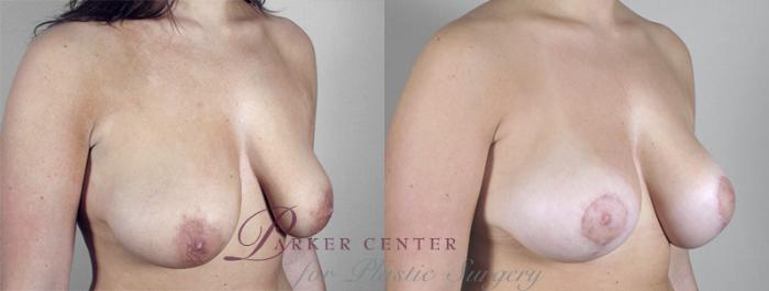 Breast Asymmetry Case 462 Before & After View #2 | Paramus, NJ | Parker Center for Plastic Surgery