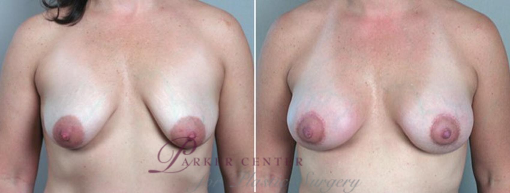 Breast Lift with Implants Case 463 Before & After View #1 | Paramus, NJ | Parker Center for Plastic Surgery