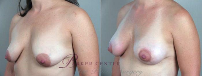 Breast Lift with Implants Case 463 Before & After View #2 | Paramus, NJ | Parker Center for Plastic Surgery