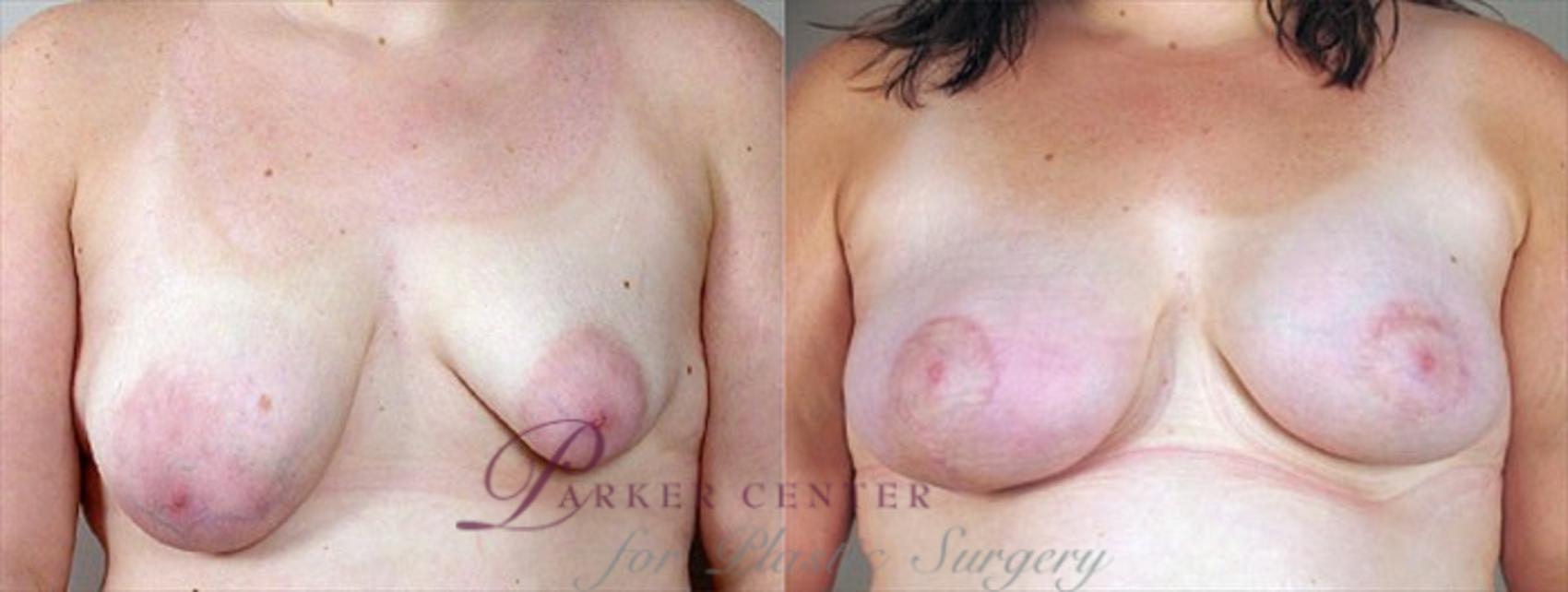Breast Asymmetry Case 464 Before & After View #1 | Paramus, NJ | Parker Center for Plastic Surgery