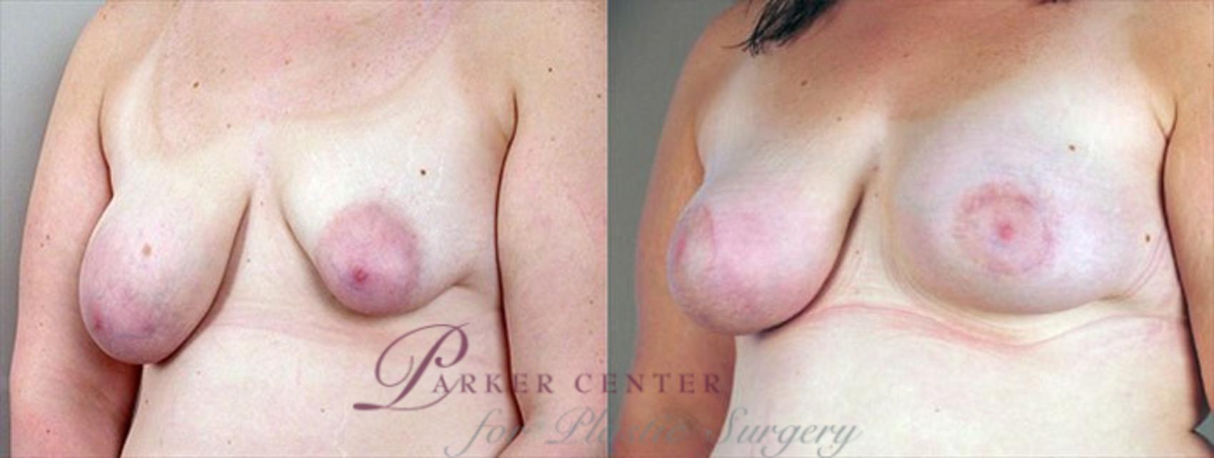 Breast Asymmetry Case 464 Before & After View #2 | Paramus, NJ | Parker Center for Plastic Surgery